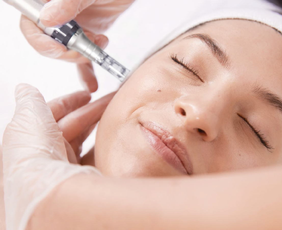 Microneedling